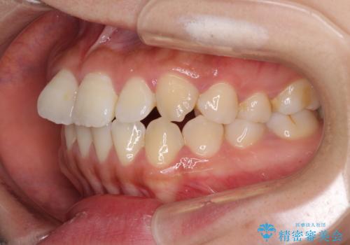 軽微な歯列不正をワイヤー矯正で整えるの治療前