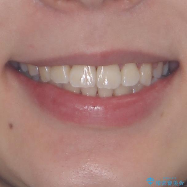 軽微な歯列不正をワイヤー矯正で整えるの治療後（顔貌）