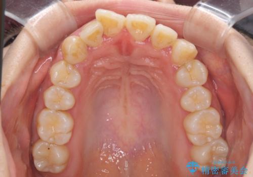 軽微な歯列不正をワイヤー矯正で整えるの治療前