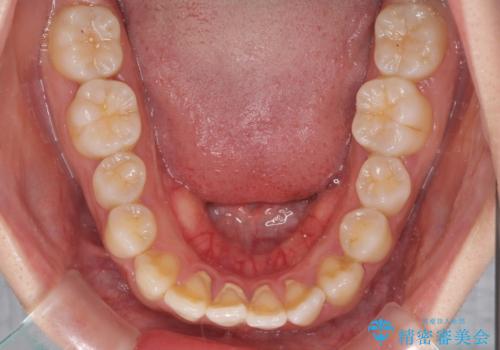 軽微な歯列不正をワイヤー矯正で整えるの治療前