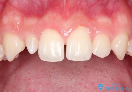 マウスピース矯正とセラミックの組み合わせ治療の治療前