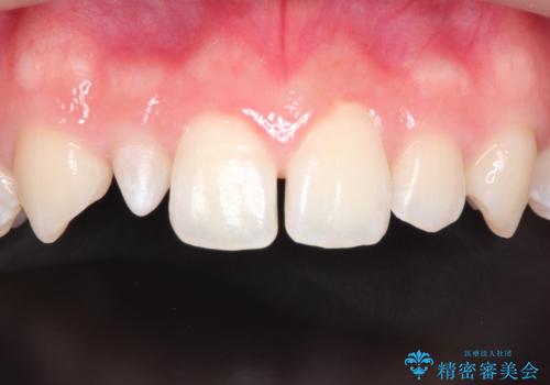マウスピース矯正とセラミックの組み合わせ治療