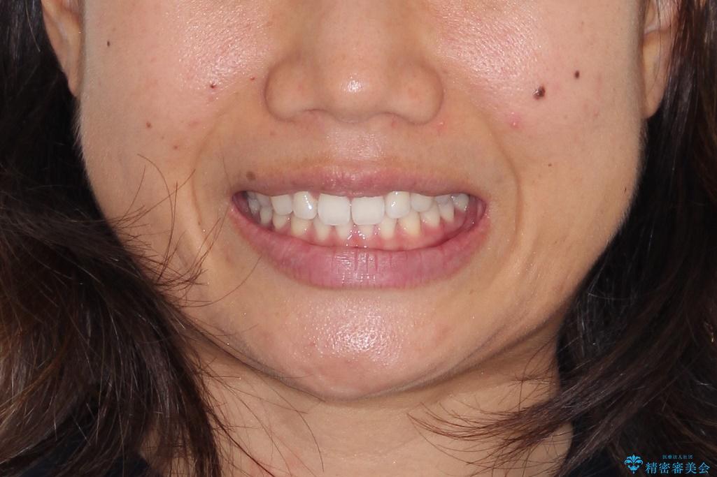 すきっ歯のインビザラインによる目立たない矯正の治療後（顔貌）