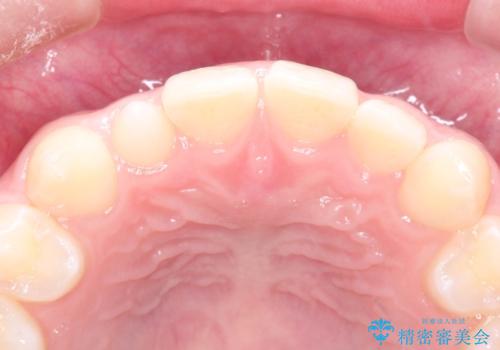 マウスピース矯正とセラミックの組み合わせ治療の治療前