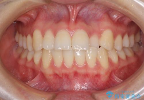 前歯のクロスバイト インビザラインによる矯正治療の症例 治療前