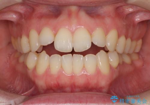 前歯の叢生とオープンバイト　インビザラインでの矯正治療の症例 治療前