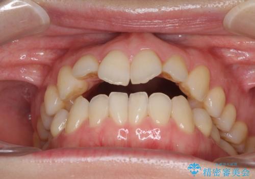 前歯の叢生とオープンバイト　インビザラインでの矯正治療の治療前