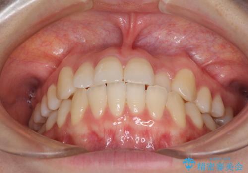 前歯のクロスバイト インビザラインによる矯正治療の治療前