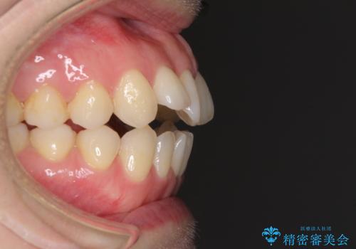 前歯の叢生とオープンバイト インビザラインでの矯正治療の治療前