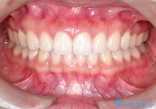 すきっ歯のインビザラインによる目立たない矯正の治療後