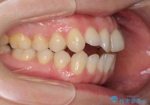 前歯の叢生とオープンバイト インビザラインでの矯正治療の治療前