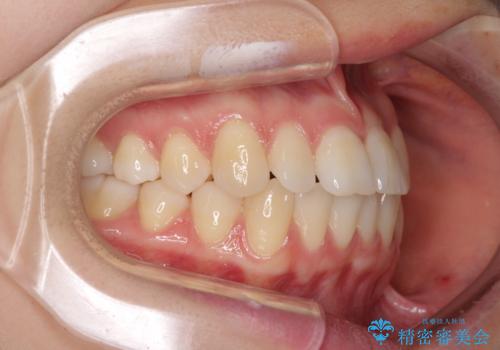 前歯のクロスバイト インビザラインによる矯正治療の治療前