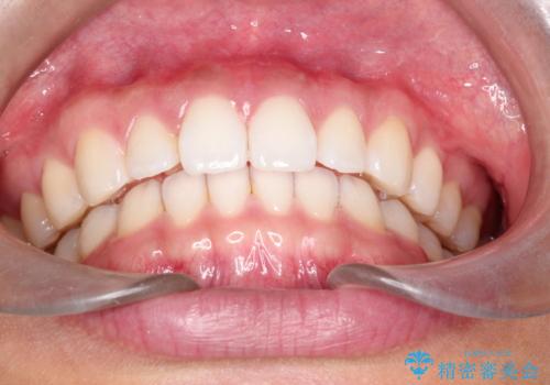 すきっ歯のインビザラインによる目立たない矯正の治療後