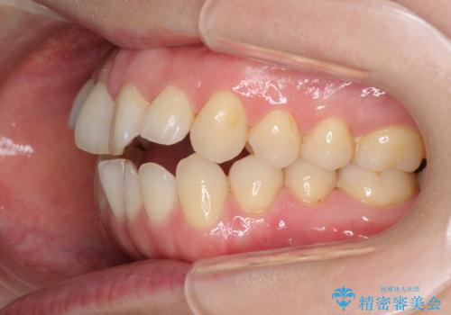 前歯の叢生とオープンバイト　インビザラインでの矯正治療の治療前