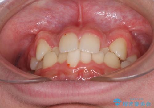 中学生のワイヤー矯正 クロスバイトを短期間で改善の治療前