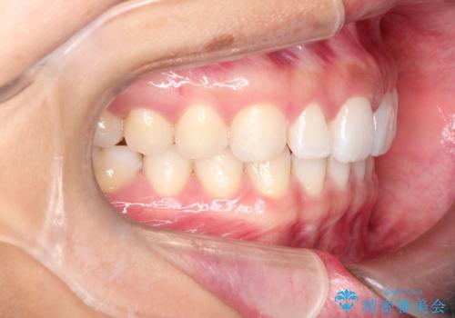 すきっ歯のインビザラインによる目立たない矯正の治療後