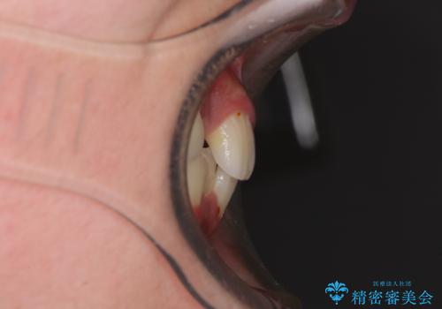 中学生のワイヤー矯正 クロスバイトを短期間で改善の治療前