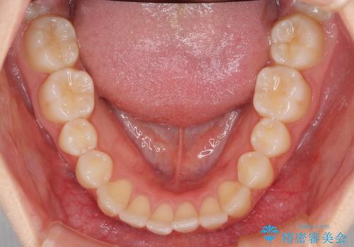 前歯のクロスバイト インビザラインによる矯正治療の治療前