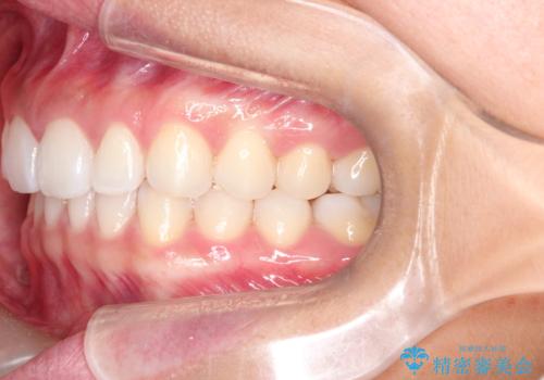 すきっ歯のインビザラインによる目立たない矯正の治療後