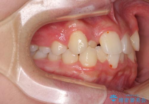 中学生のワイヤー矯正 クロスバイトを短期間で改善の治療前