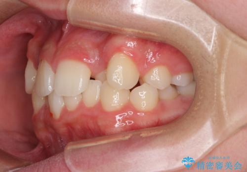 中学生のワイヤー矯正 クロスバイトを短期間で改善の治療前