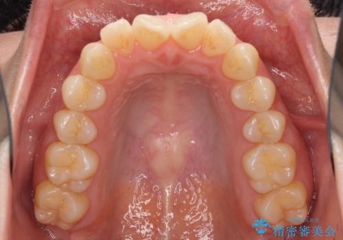 前歯の叢生とオープンバイト インビザラインでの矯正治療の治療前