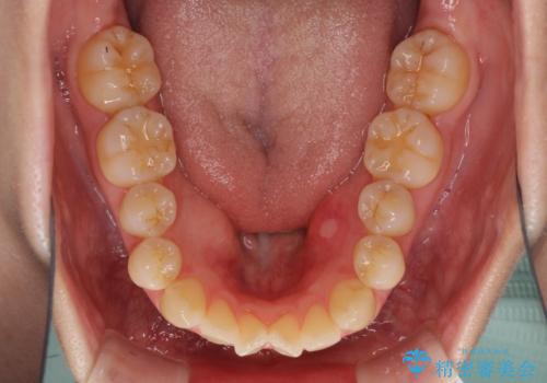 前歯の叢生とオープンバイト インビザラインでの矯正治療の治療前