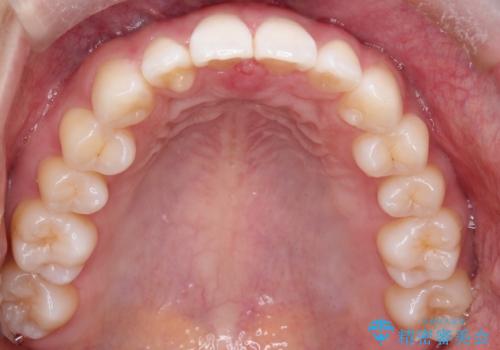 すきっ歯のインビザラインによる目立たない矯正の治療後