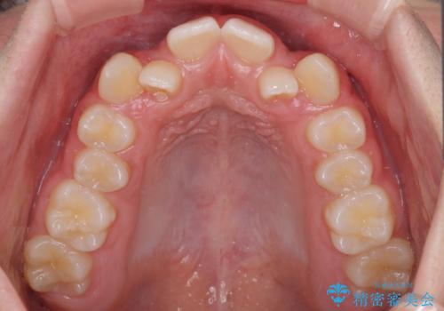 中学生のワイヤー矯正 クロスバイトを短期間で改善の治療前