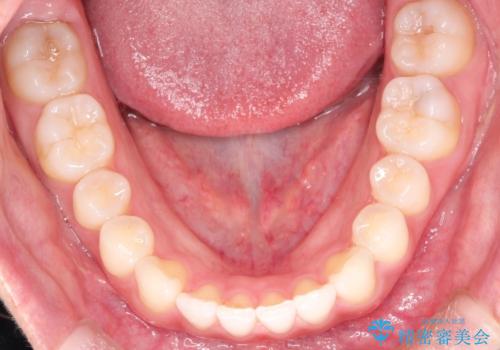 すきっ歯のインビザラインによる目立たない矯正の治療後