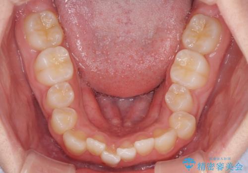中学生のワイヤー矯正 クロスバイトを短期間で改善の治療前