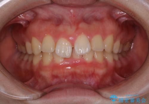 矯正治療前にPMTCで口元のケアの治療後