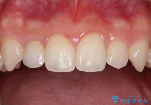 マウスピース矯正とセラミックの組み合わせ治療の治療後