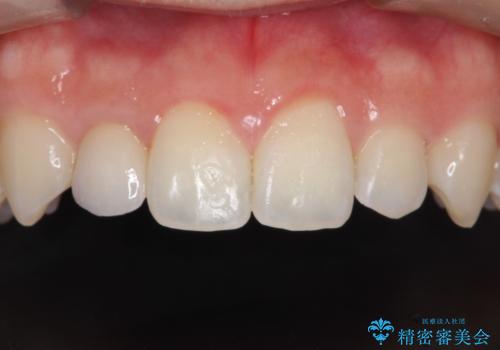 マウスピース矯正とセラミックの組み合わせ治療の治療後