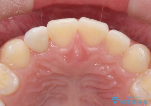 マウスピース矯正とセラミックの組み合わせ治療の治療後