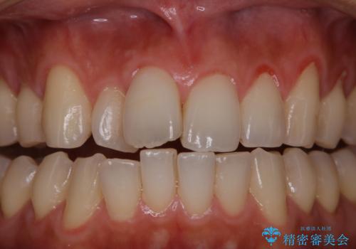 PMTCで清潔感ある口元にの治療前