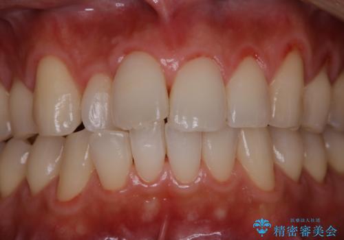 PMTCで清潔感ある口元にの治療後