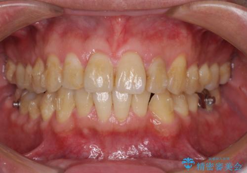 前歯のデコボコと下顎の八重歯　インビザラインによる矯正治療の治療中