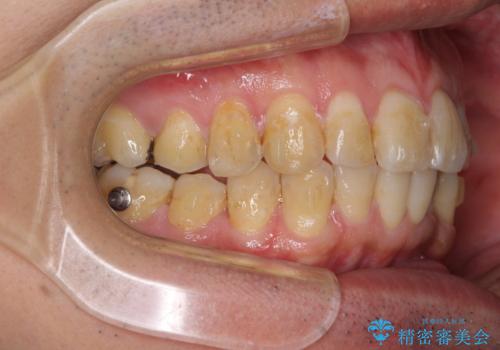 前歯のデコボコと下顎の八重歯 インビザラインによる矯正治療の治療中