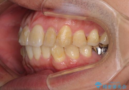 前歯のデコボコと下顎の八重歯 インビザラインによる矯正治療の治療中