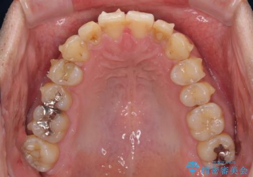 前歯のデコボコと下顎の八重歯 インビザラインによる矯正治療の治療中