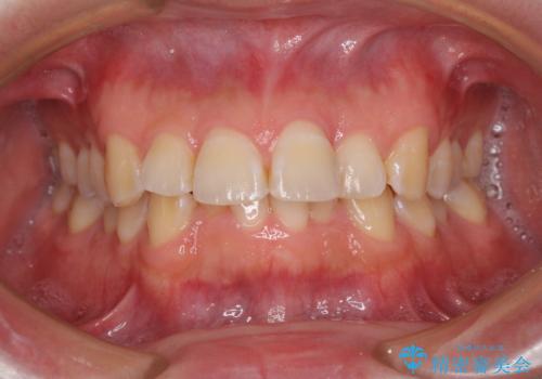 ディープバイトと叢生を解消 インビザライン矯正の症例 治療前