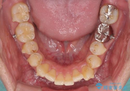 前歯のデコボコと下顎の八重歯　インビザラインによる矯正治療の治療中