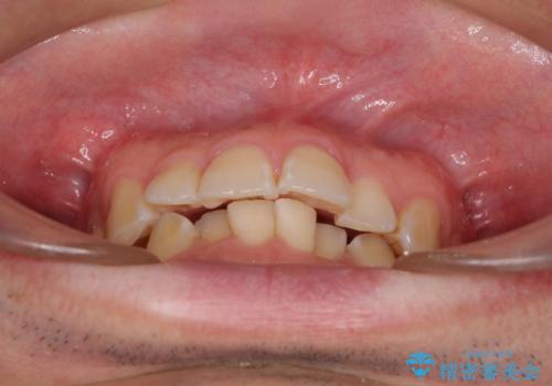 ディープバイトと叢生を解消 インビザライン矯正の治療前
