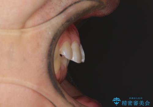 ディープバイトと叢生を解消 インビザライン矯正の治療前