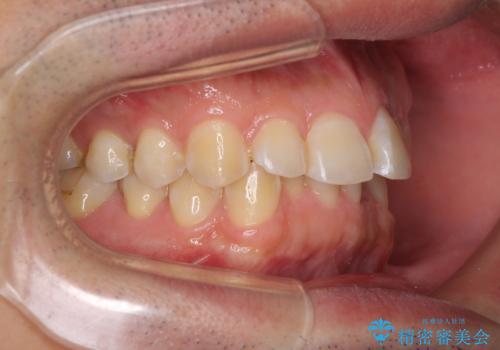 ディープバイトと叢生を解消 インビザライン矯正の治療前