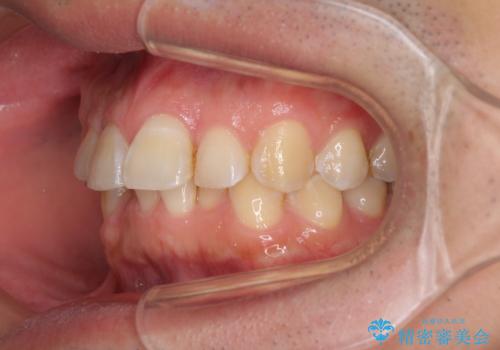ディープバイトと叢生を解消 インビザライン矯正の治療前