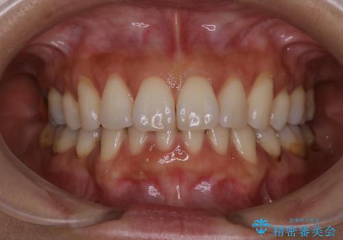 全体の総合的な治療前にPMTC