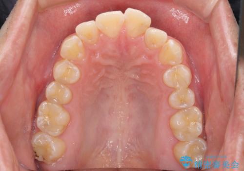 ディープバイトと叢生を解消 インビザライン矯正の治療前