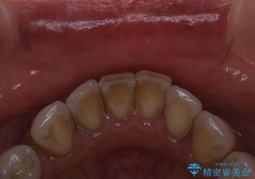 全体の総合的な治療前にPMTCの治療前